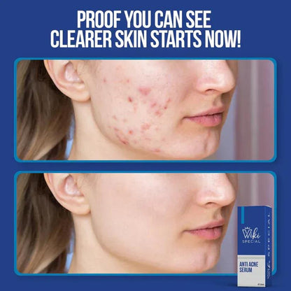 Wiki Anti Acne Serum 30ml Skin Brightening