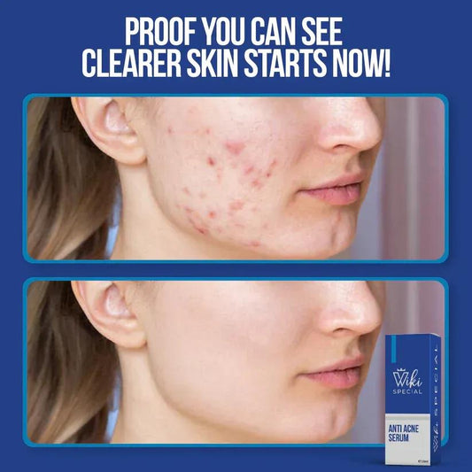 Wiki Anti Acne Serum 30ml Skin Brightening
